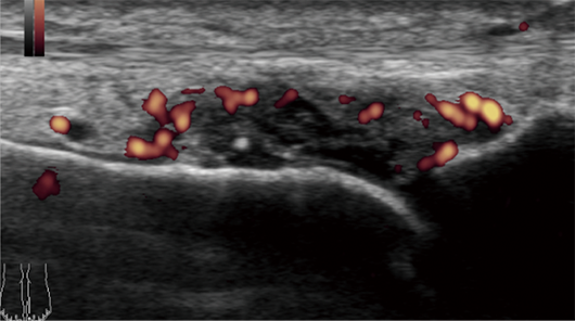 超音波検査パワードプラ法による痛風発作時の滑膜炎所見画像